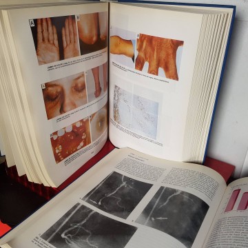 Aterosclerosis y enfermedad arterial coronaria Valentín Fuster libro