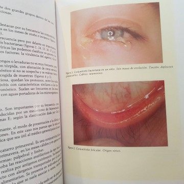 Libros de oftalmología medicina conjuntivitis libro librería online