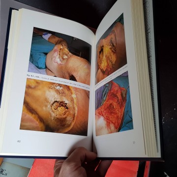Quemaduras tratamiento de urgencia libro de medicina tratamiento