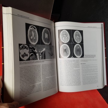 Libros neurología medicina enfermedades vasculares cerebrales comprar