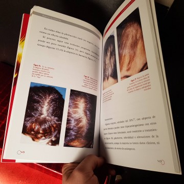 Alopecia en la mujer, Aurora guerra calvicie libro librería online