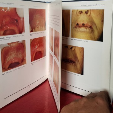 APLICACIONES DEL LÁSER DE CO2 EN ODONTOLOGÍA.
