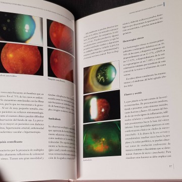 Alteraciones vitreorretinianas predisponentes al desprendimiento de retina.