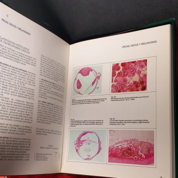 Los melanomas uveales, hsitología y clínica, Sergio Bonafonte Royo.