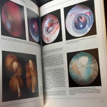 Retinoblastoma y otras causas de leucocoria en el niño, J.J. Gil Gibernau.