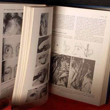 Cirujía reparadora y reconstructora de la región orbital, J.C. Mustardé.