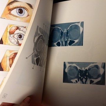 Anatomía radiológica de la órbita y globo ocular.