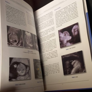 Nociones para el diagnóstico prenatal de malformaciones embrionarias y fetales, JM.Bajo Arenas.