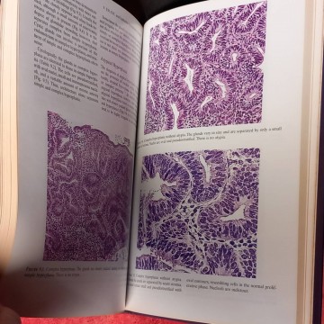 Diagnosis of endomentrial biopsies and curetings, Michael T. Mazur.