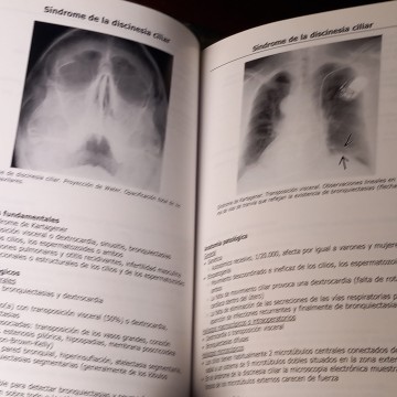 LOS 100 DIAGNÓSTICOS PRINCIPALES EN TÓRAX, SERIE RADIOLOGÍA CLÍNICA.