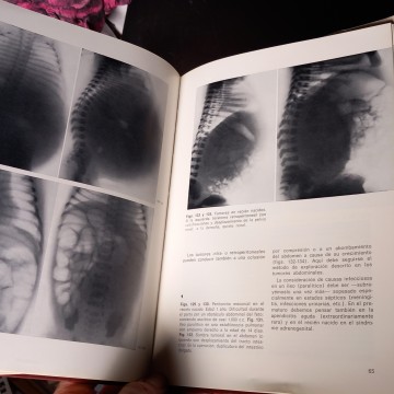 EL ABDOMEN AGUDO EN PEDIATRÍA, H.G. WOLF.