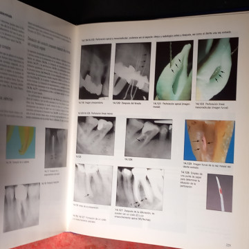 ATLAS EN COLOR Y TEXTO DE ENDODONCIA.