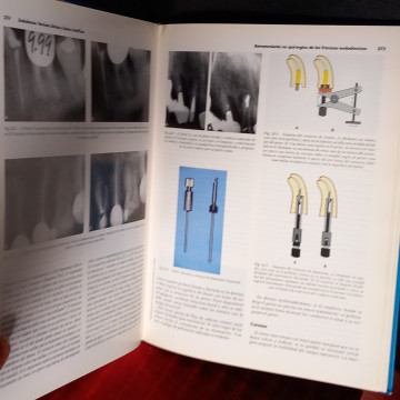 ENDODONCIA, TÉCNICAS CLÍNICAS Y BASES CIENTÍFICAS, CARLOS CANALDA SAHLI.